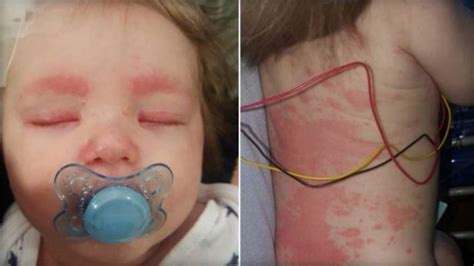 meningitis rash toddler